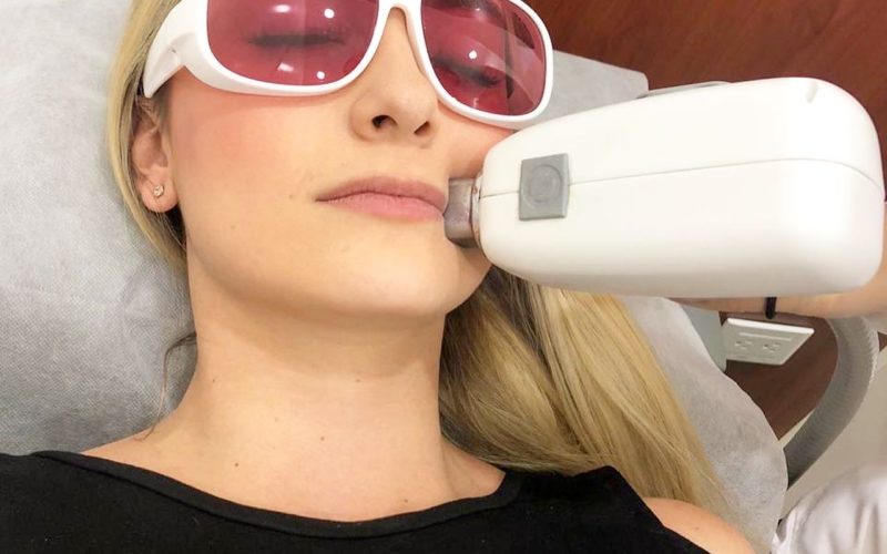 Depilación con Láser Diodo