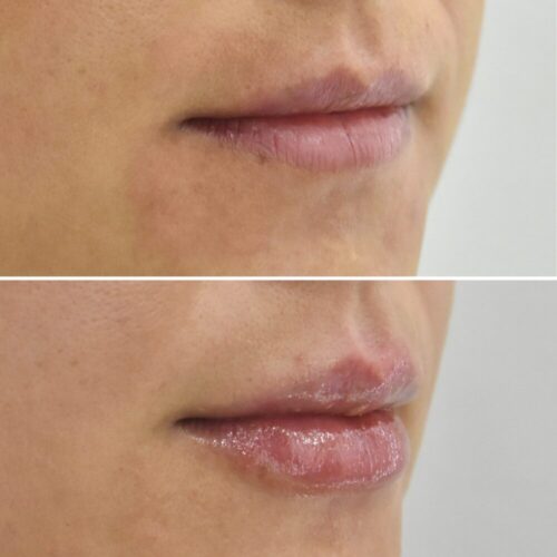 Hyaluronic acid labios hidratados