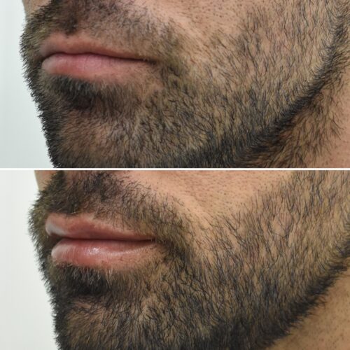 Ácido hialuronico labios