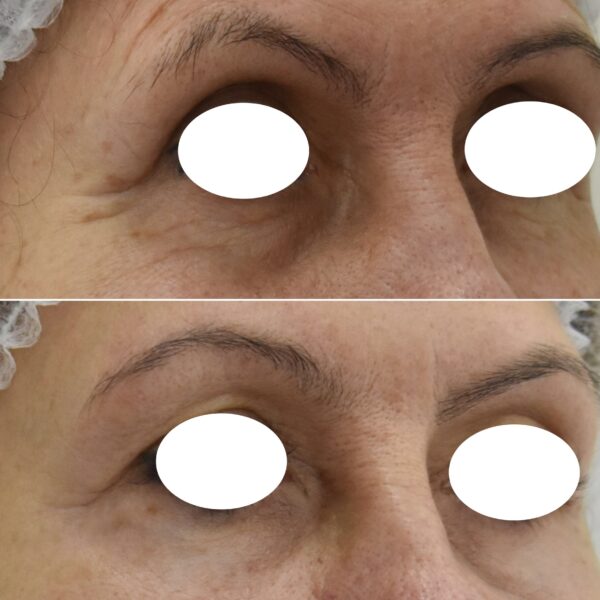 Aplicación de 50 unidades de Toxina Botulínica