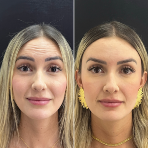 Toxina Botulínica | Naturalness Medellín | Medicina Estética