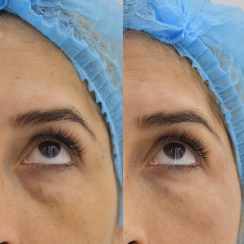 Ácido hialuronico ojeras