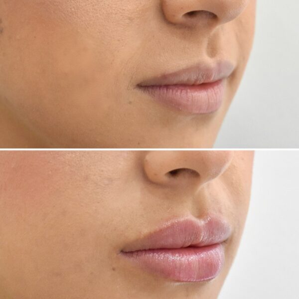 labios ácido hialurónico