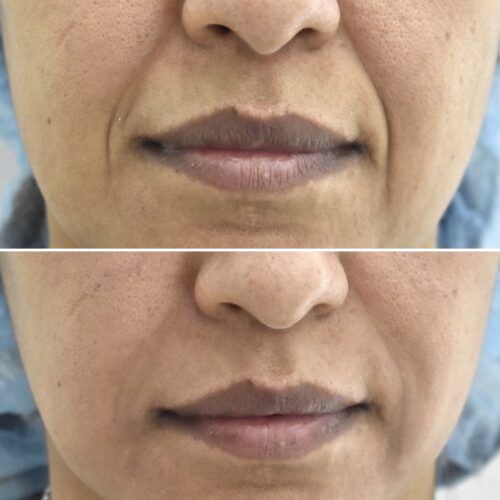 Ácido Hialurónico, una opción para mejorar los surcos nasogenianos.