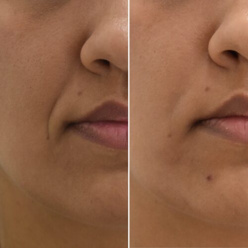 Ácido Hialurónico, una opción para mejorar los surcos nasogenianos.