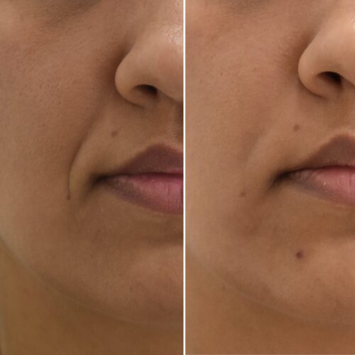 Ácido Hialurónico en Surcos Nasogenianos