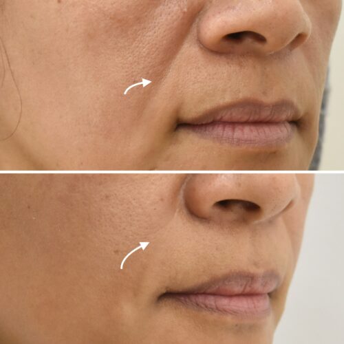 Ácido Hialurónico en Surcos Nasogenianos