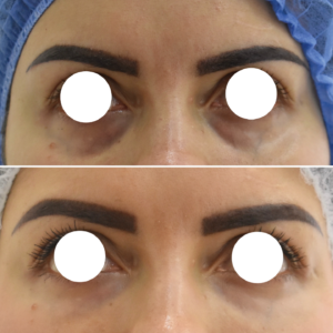 Ácido Hialurónico en Ojeras | Naturalness Medellín | Medicina Estética