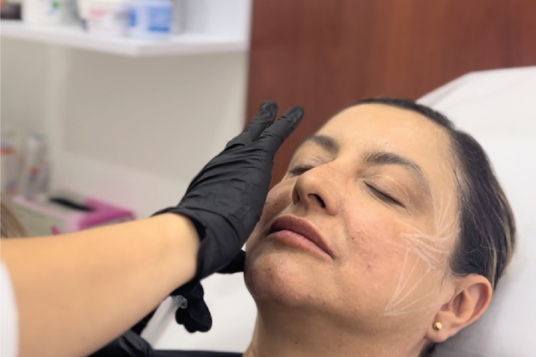 Sculptra | Naturalness Medellín | Medicina Estética Sculptra | Naturalness Medellín | Medicina Estética