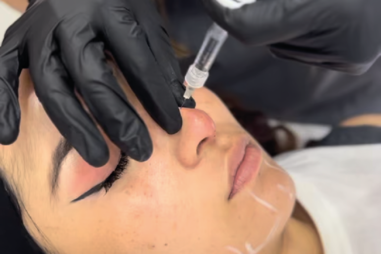 Rinomodelación con Ácido Hialurónico | Naturalness Medellín | Medicina Estética Rinomodelación con Ácido Hialurónico | Naturalness Medellín | Medicina Estética