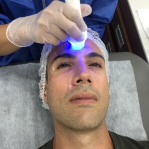 Rejuvenecimiento con Radiofrecuencia Tripolar Facial (8 sesiones)