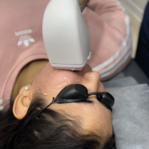 Depilación Láser Diodo en Área Pequeña | Naturalness Medellín | Medicina Estética