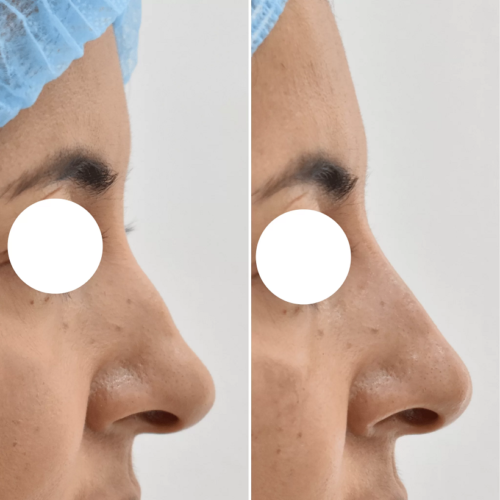 Rhinomodelation with Hyaluronic Acid