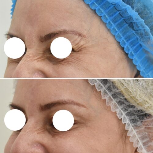 Before and After | Naturalness