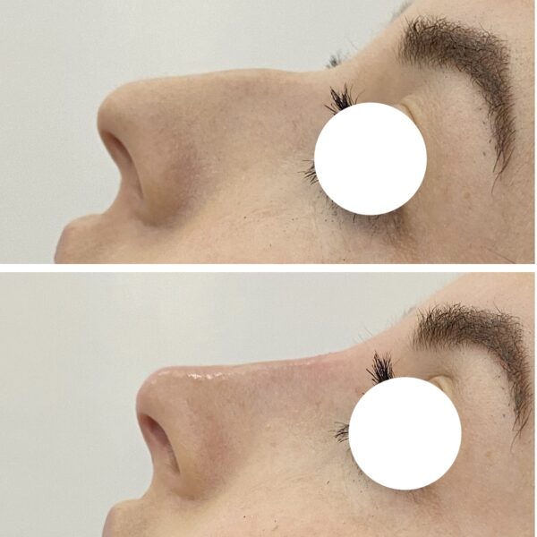 Antes y Despues | Naturalness