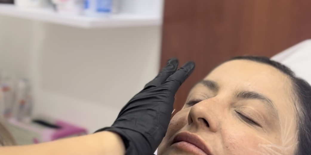 Sculptra | Naturalness Medellín | Medicina Estética Sculptra | Naturalness Medellín | Medicina Estética