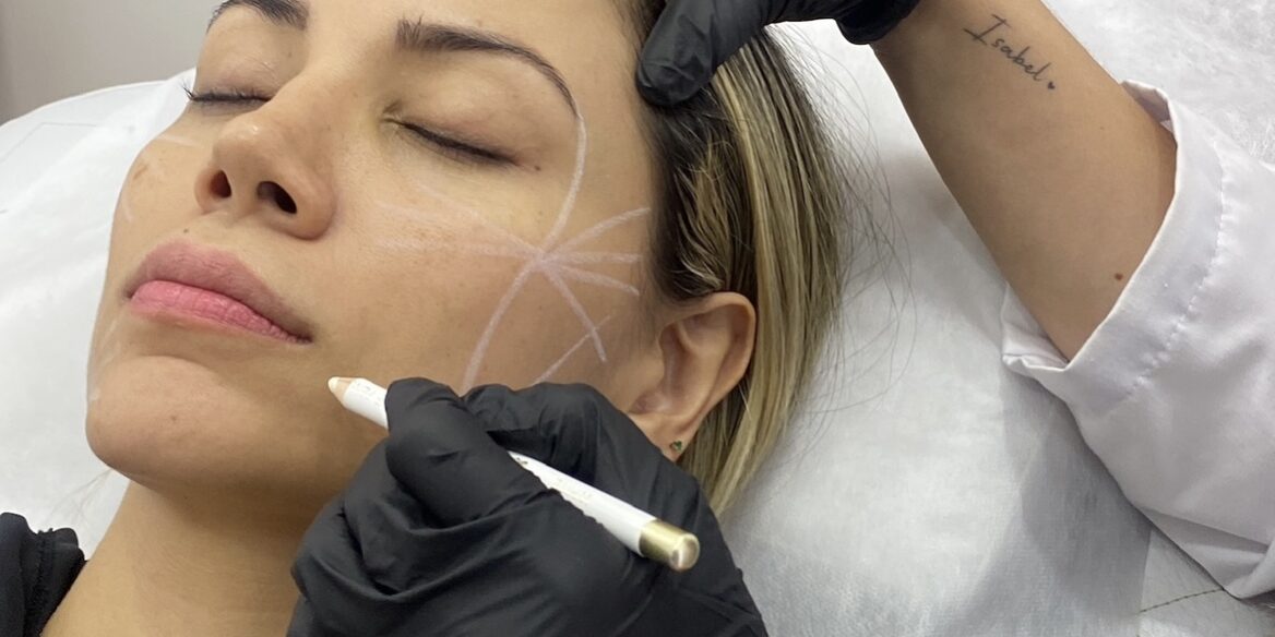 Radiesse | Naturalness Medellín | Medicina Estética Radiesse | Naturalness Medellín | Medicina Estética