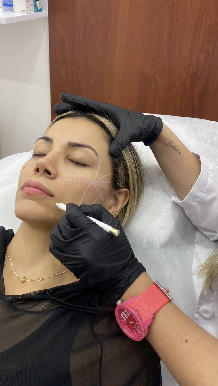 Radiesse | Naturalness Medellín | Medicina Estética Radiesse | Naturalness Medellín | Medicina Estética