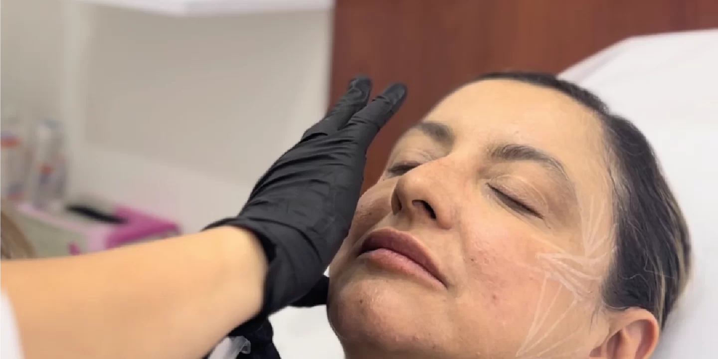 Sculptra | Naturalness Medellín | Medicina Estética