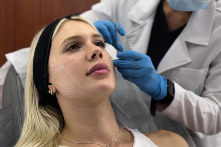 Radiesse | Naturalness Medellín | Medicina Estética Radiesse | Naturalness Medellín | Medicina Estética