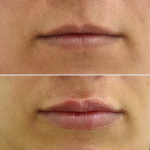 Ácido Hialurónico Labios Landing | Naturalness