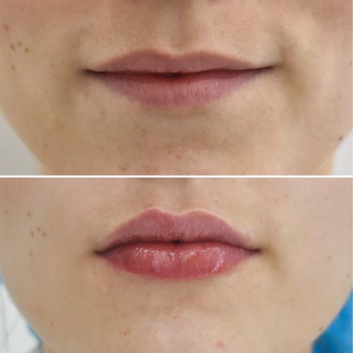 Ácido Hialurónico Labios Landing | Naturalness