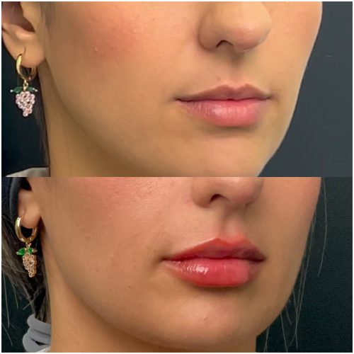 Ácido Hialurónico Labios Landing | Naturalness