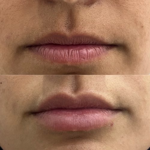 Ácido Hialurónico Labios Landing | Naturalness