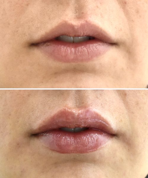 Ácido Hialurónico Labios Landing | Naturalness