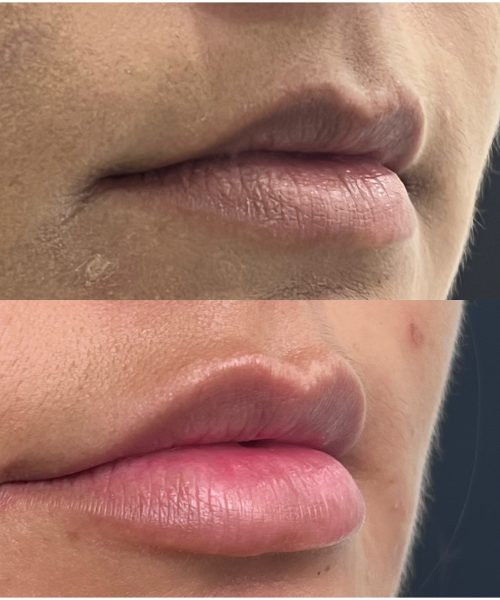 Ácido Hialurónico Labios Landing | Naturalness