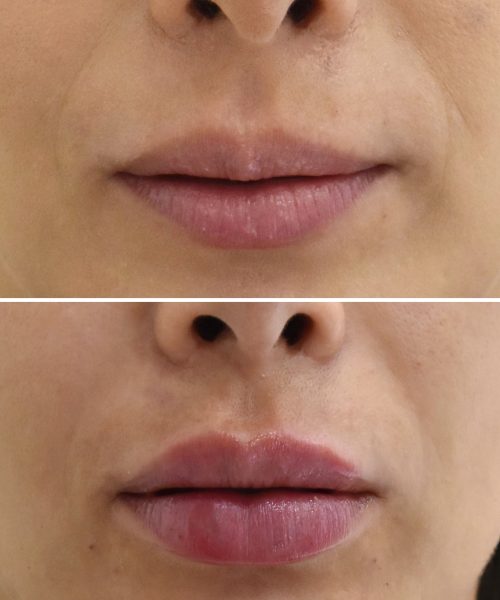 Ácido Hialurónico Labios Landing | Naturalness