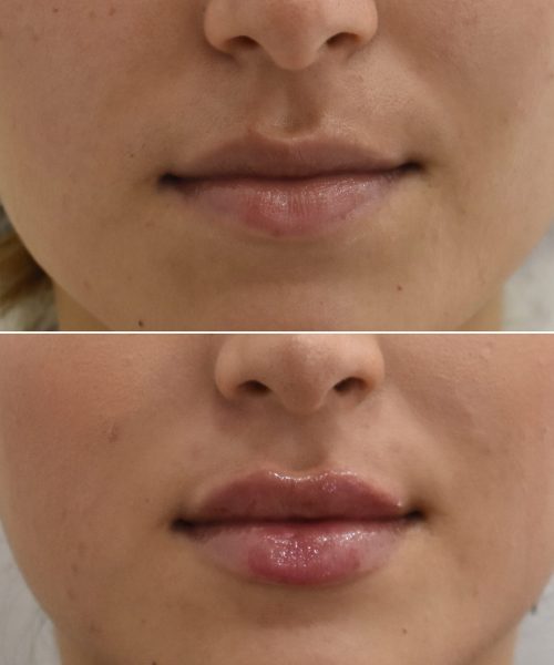 Ácido Hialurónico Labios Landing | Naturalness